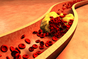 clogged artery with platelets and cholesterol plaque